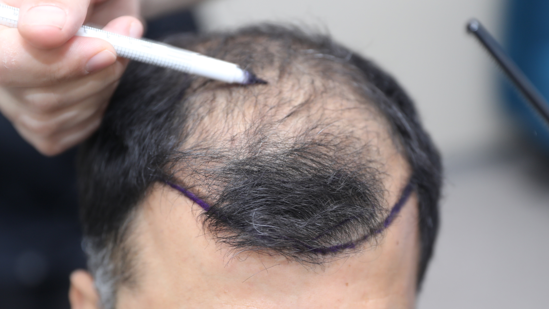 a patient having a hair transplant