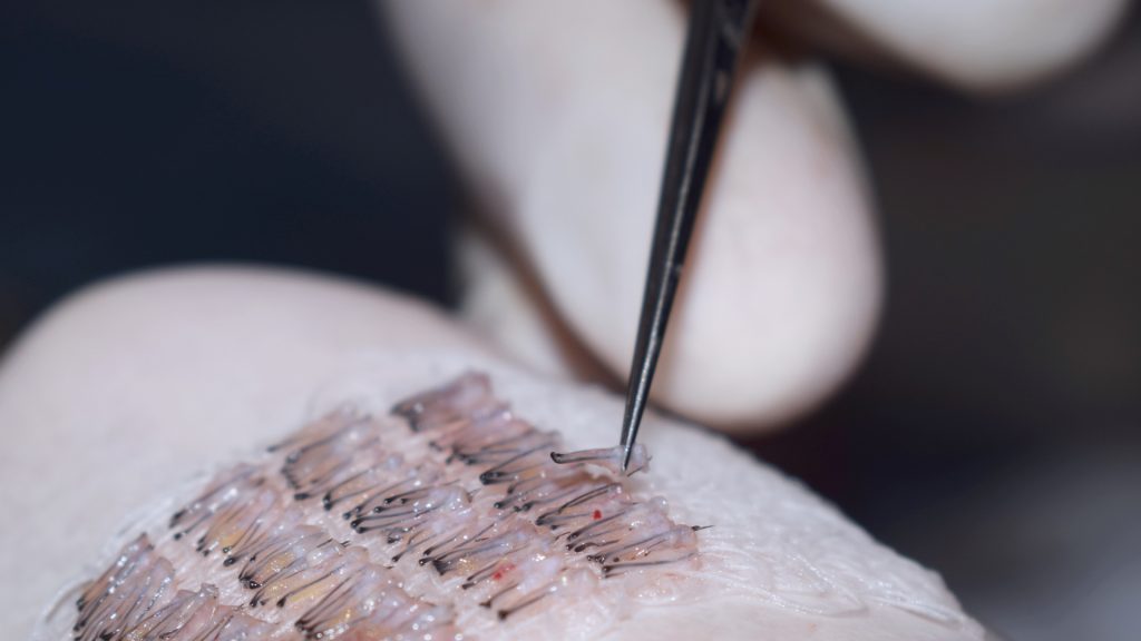 Failed hair transplant: how to avoid it and how to correct it? Failed hair transplant: how to avoid it and how to correct it?