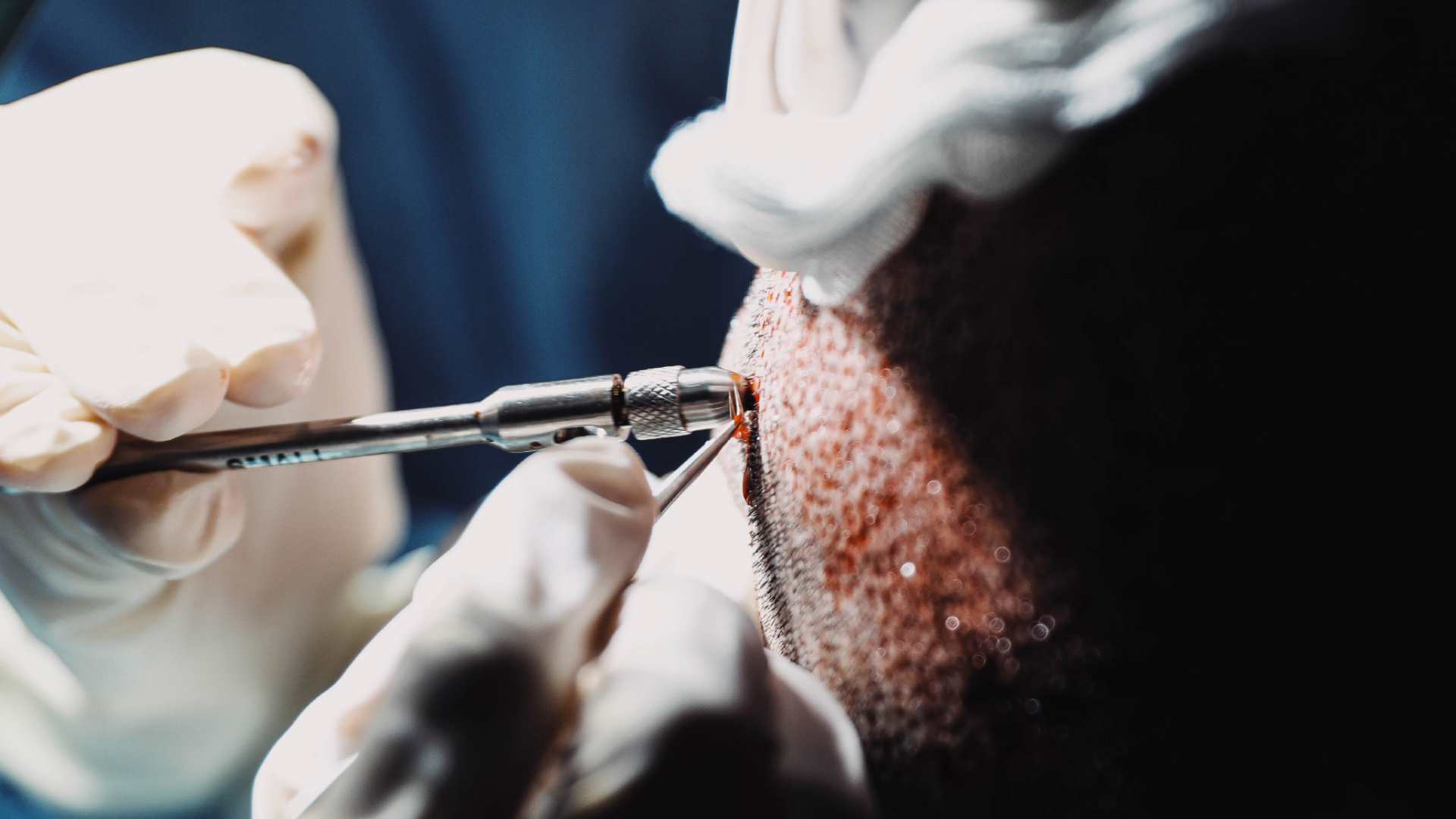 a manual extraction of hair grafts