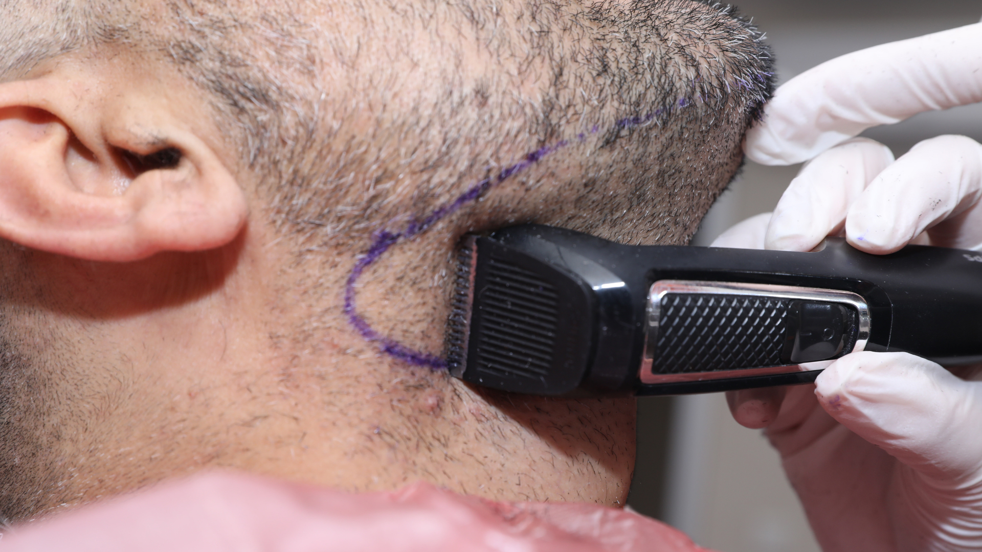 a patient getting his beard shaved before a beard transplant