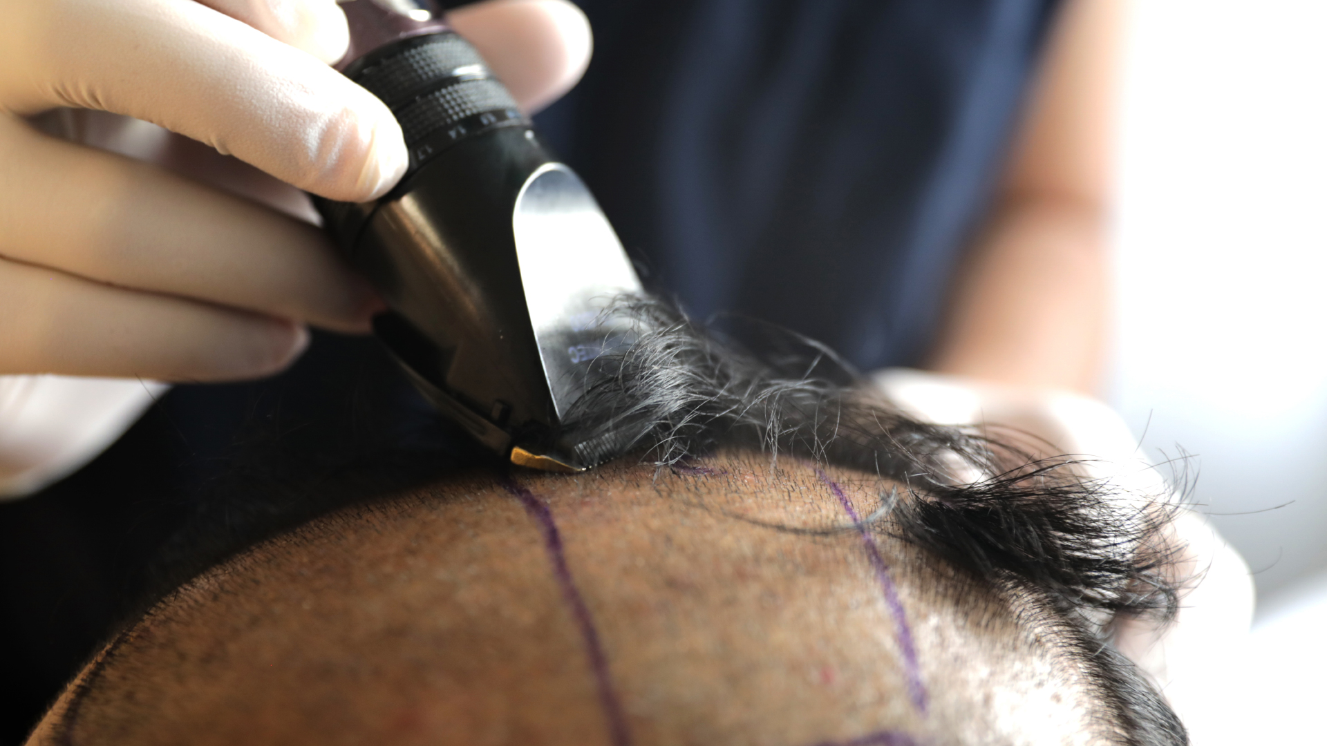 une personne se fait raser les cheveux avant une greffe capillaire