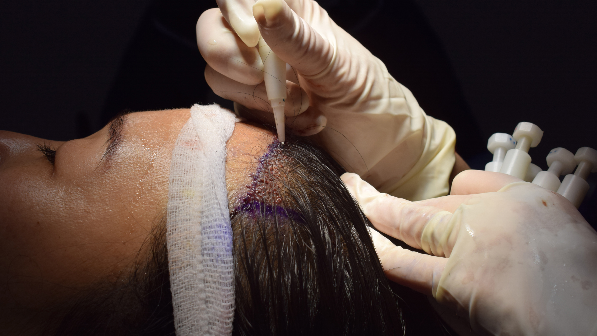 a patient having a DHI hair transplant without shaving