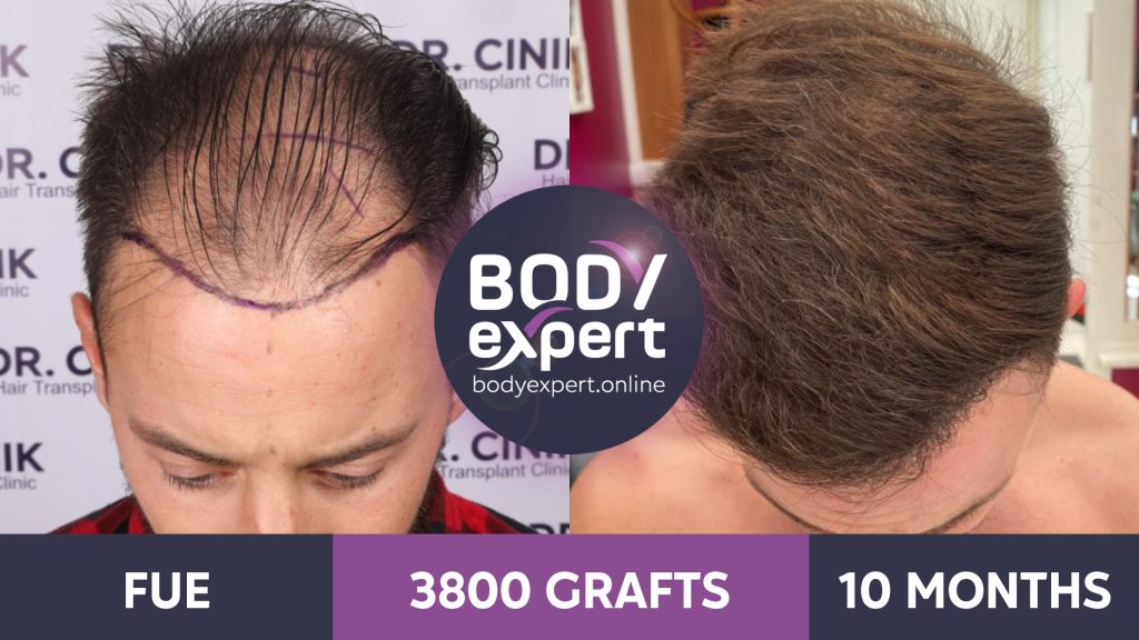 Korea Hair Transplant Center  Transplanted Hair Growth Timeline