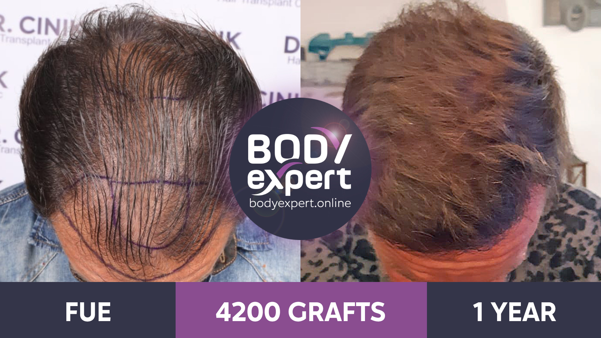 Hair Transplant before and after photos Body Expert