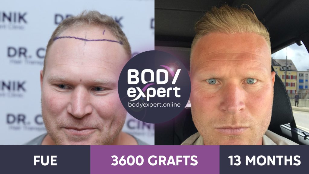 EN-AP-Greffe-de-Cheveux-06