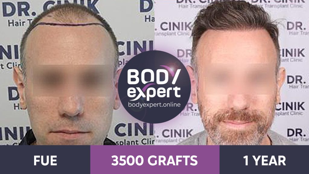 Hair Transplant : before and after photos | Body Expert Hair Transplant : before and after photos | Body Expert