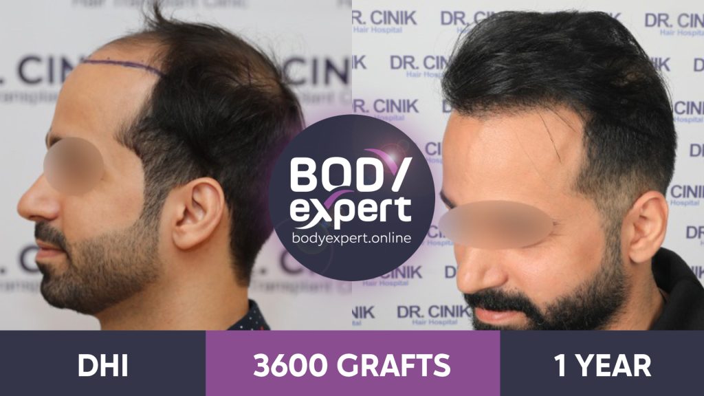 Hair Transplant : before and after photos | Body Expert Hair Transplant : before and after photos | Body Expert
