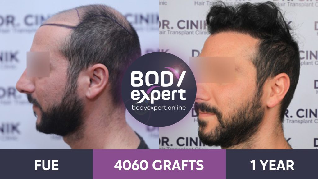 EN-AP-Greffe-de-Cheveux-21