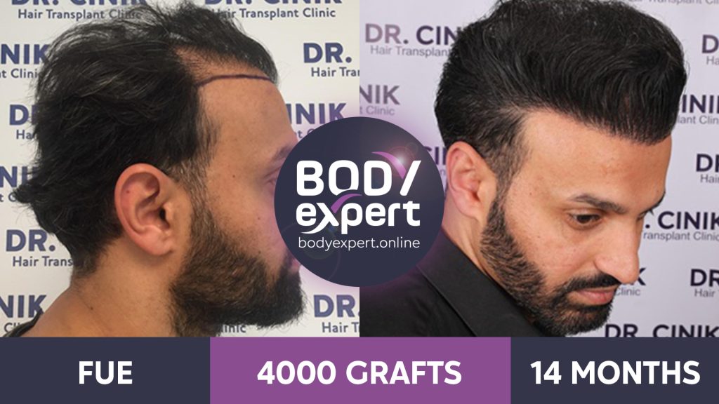 EN-AP-Greffe-de-Cheveux-24