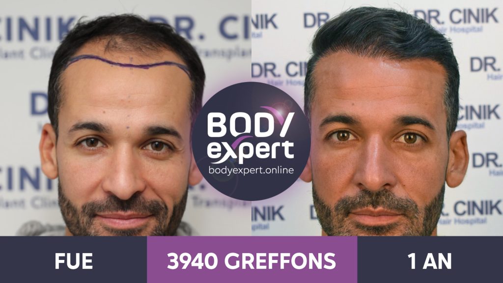 FR-AP-Greffe-de-Cheveux-03