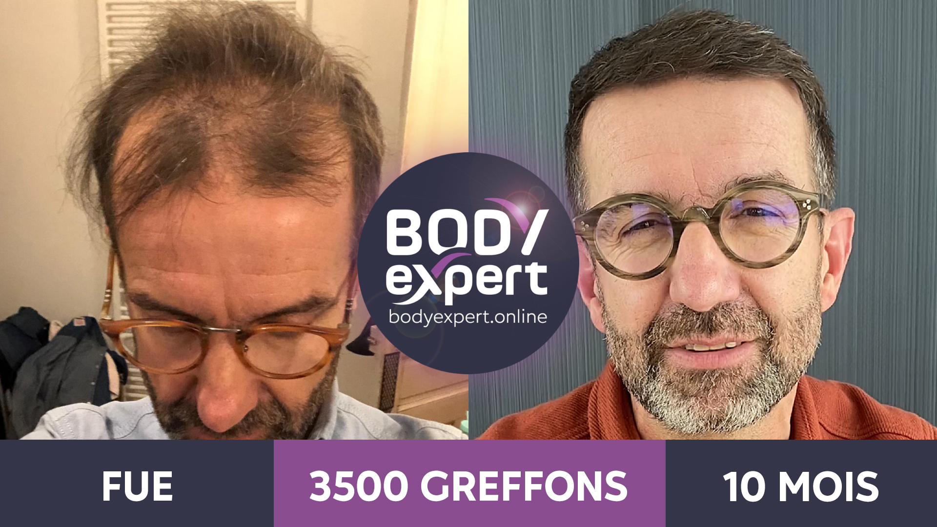 Greffe de cheveux avant après les résultats en photos — free download