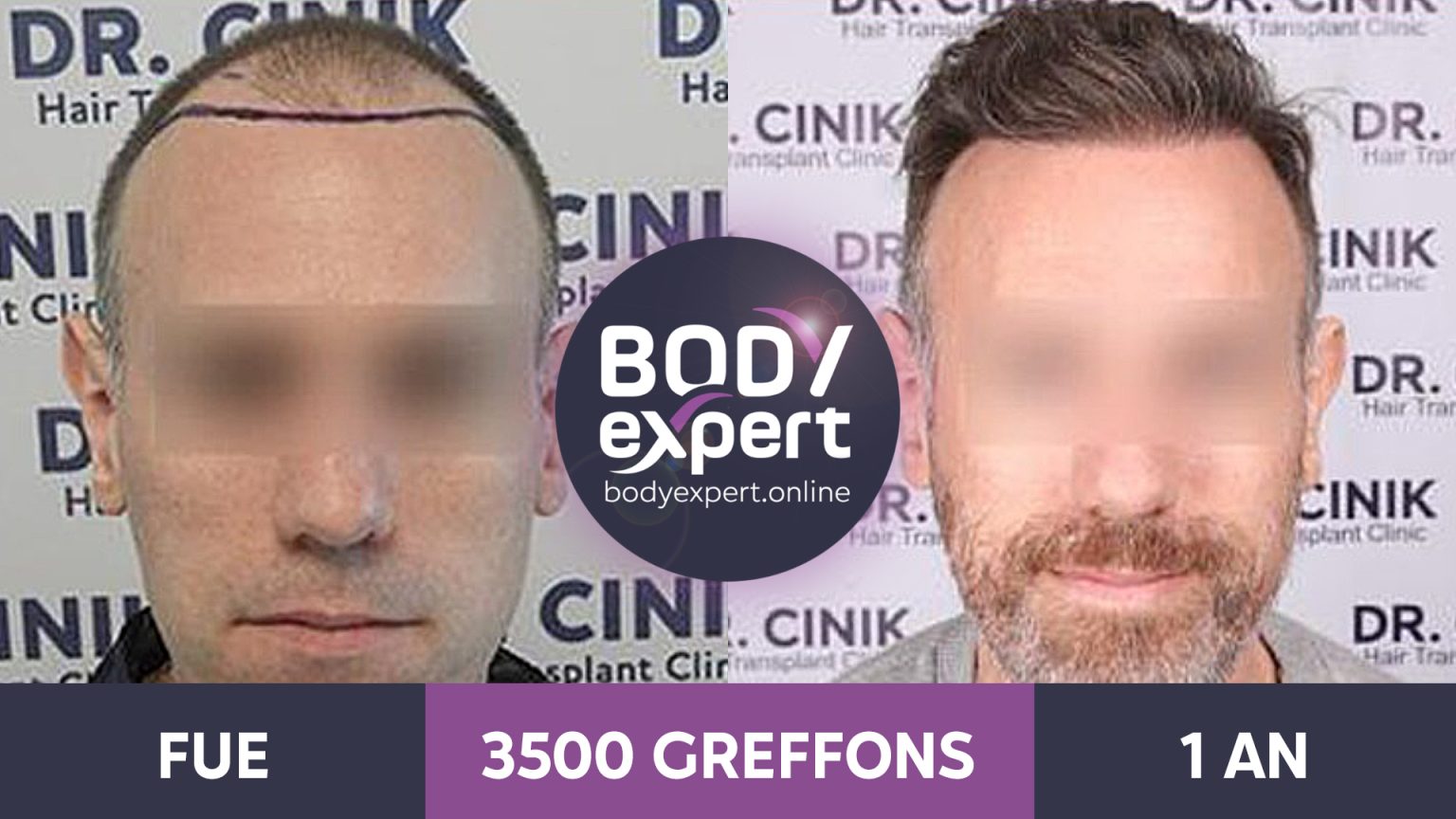 Greffe de cheveux avant après les résultats en photos — free download