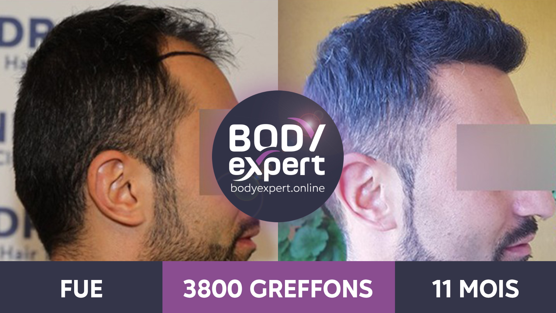 Greffe de cheveux avant après les résultats en photos — free download