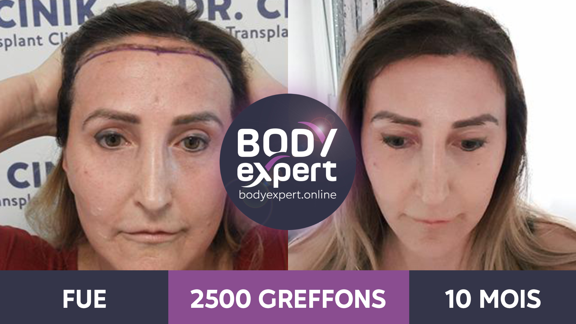 Greffe de cheveux avant après les résultats en photos — free download