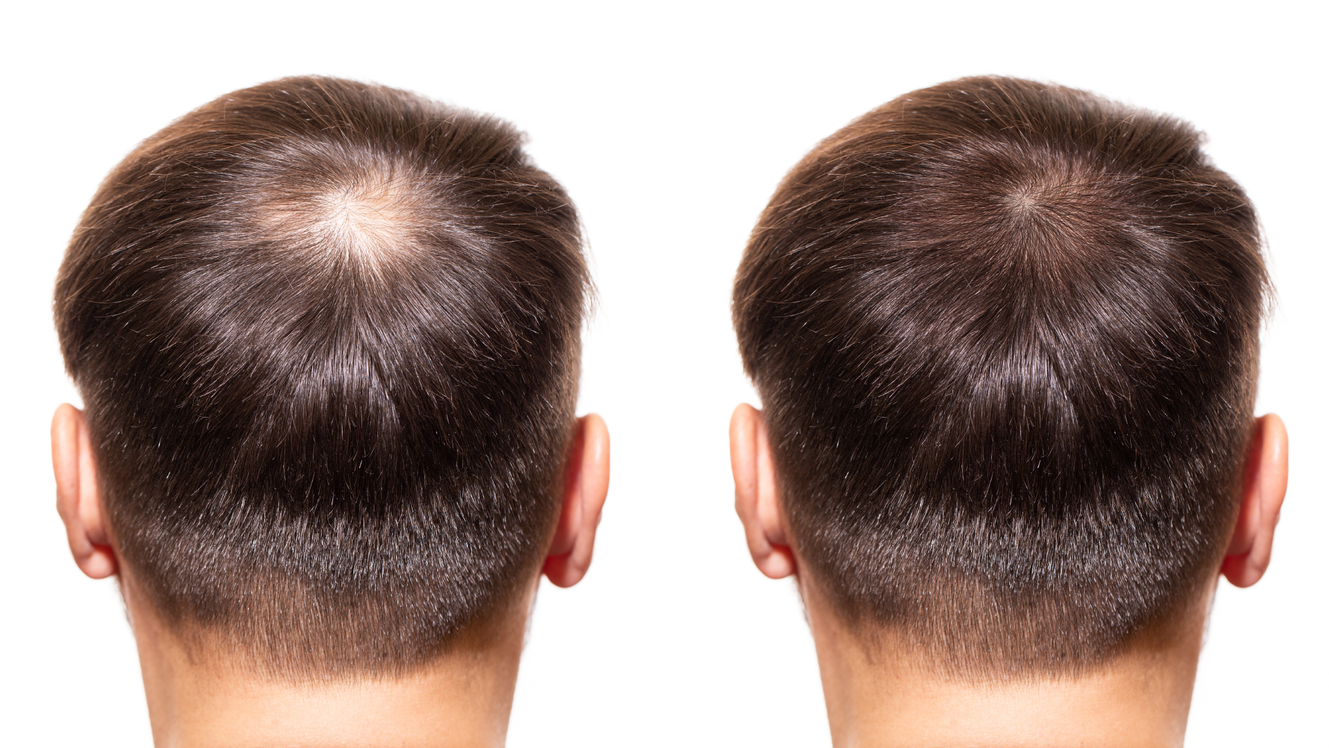 Second hair transplant: why and how to proceed?