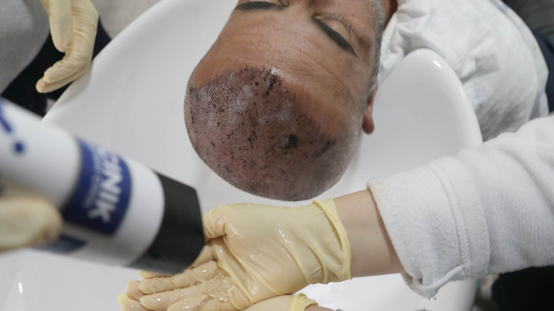 post-operative care following a hair transplant