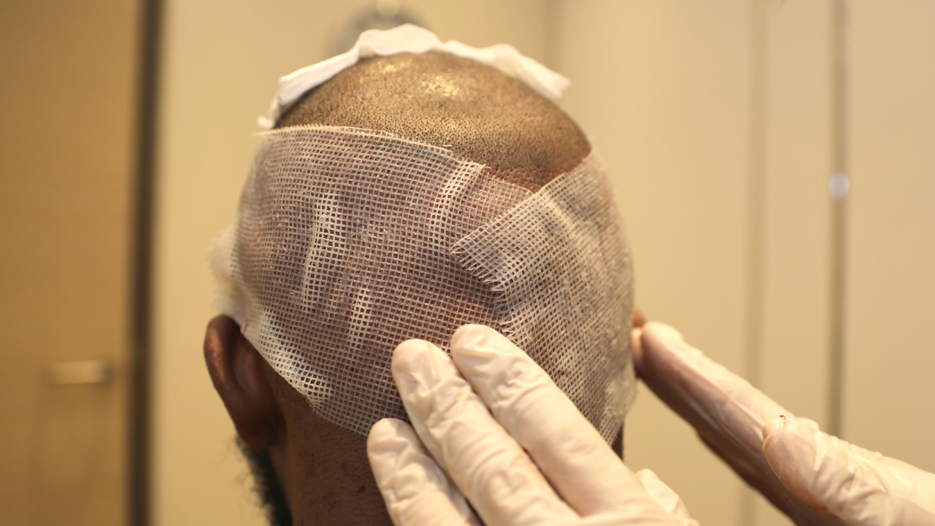 un homme subit des soins après sa greffe de cheveux