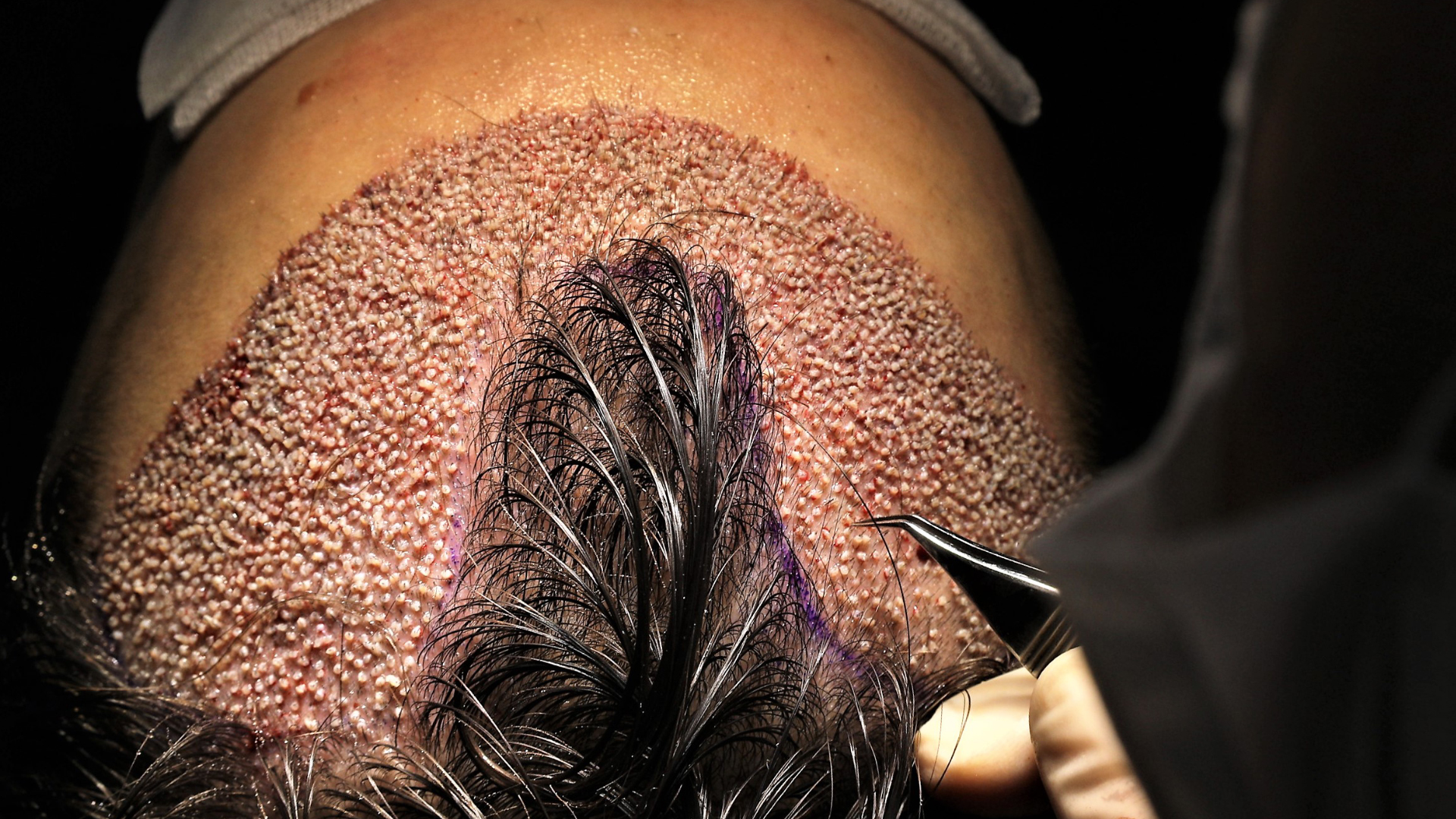 un patient se fait implanter des follicules capillaire dans le cadre d’une greffe de cheveux