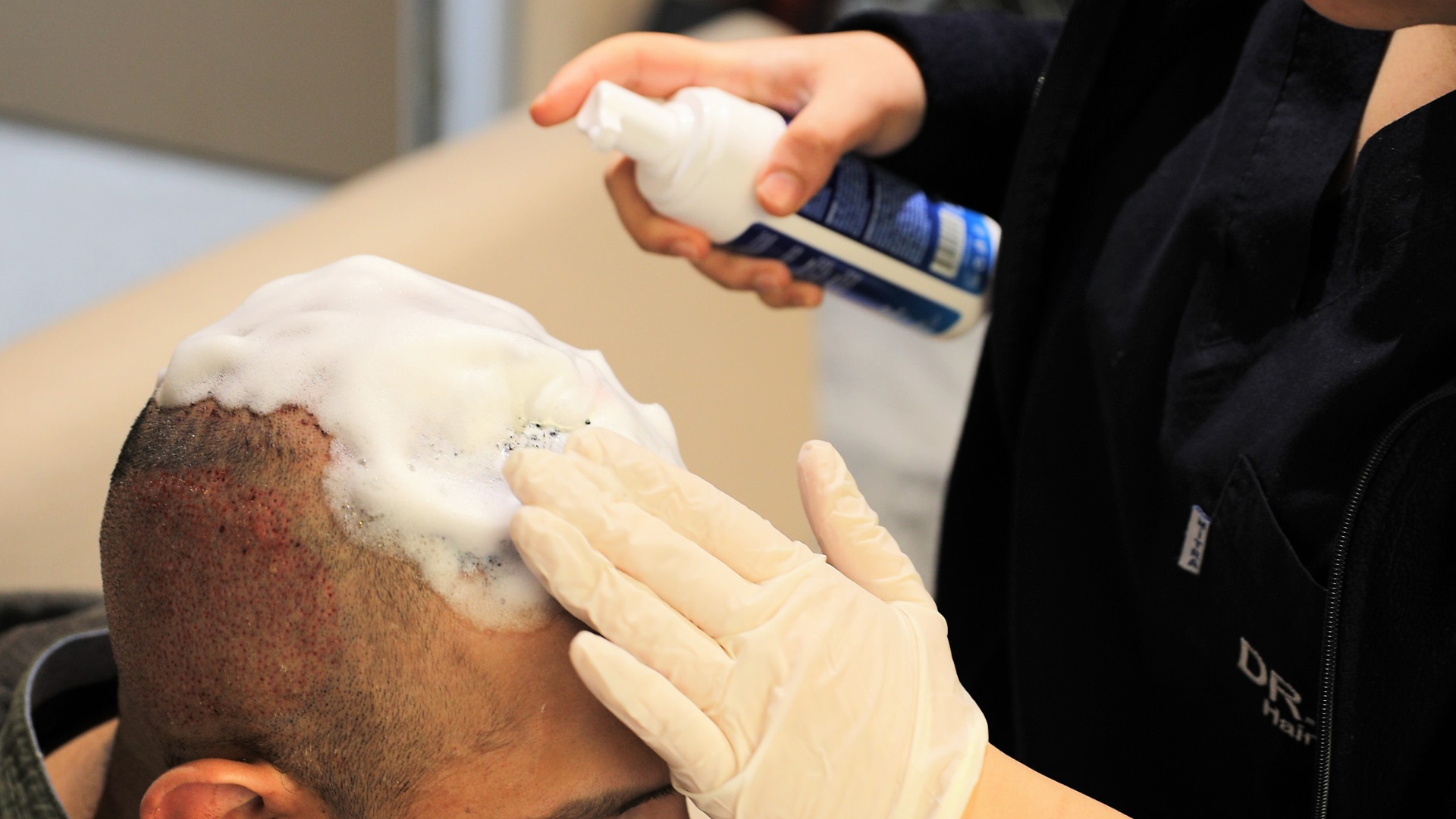 le premier shampooing après une greffe de cheveux