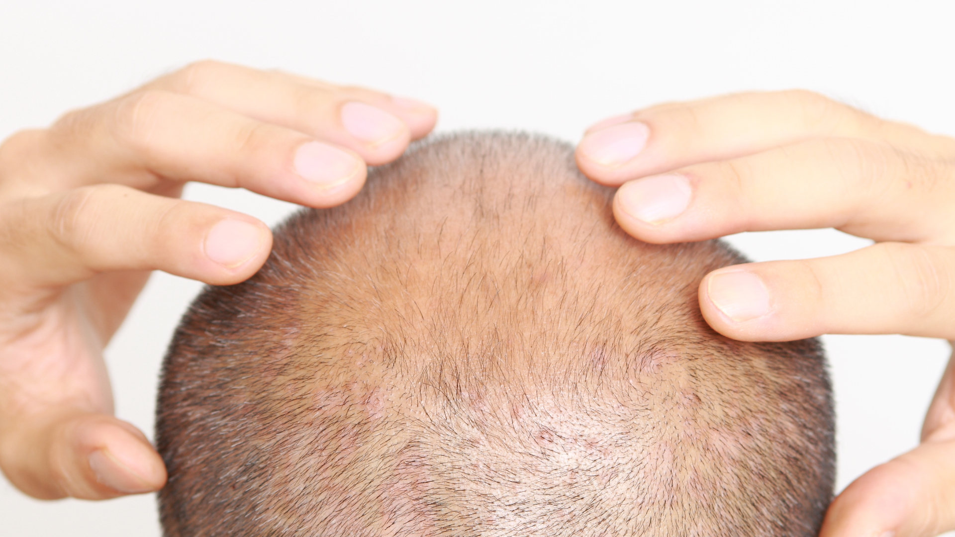 the regrowth phase after a hair transplant
