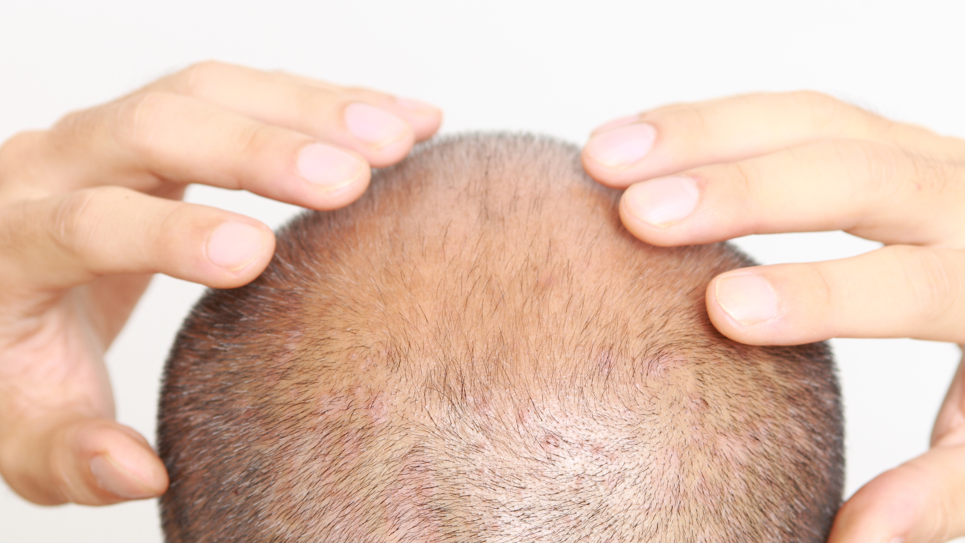 Young Indian men are battling a chronic hair fall problem Heres how they  can reverse it