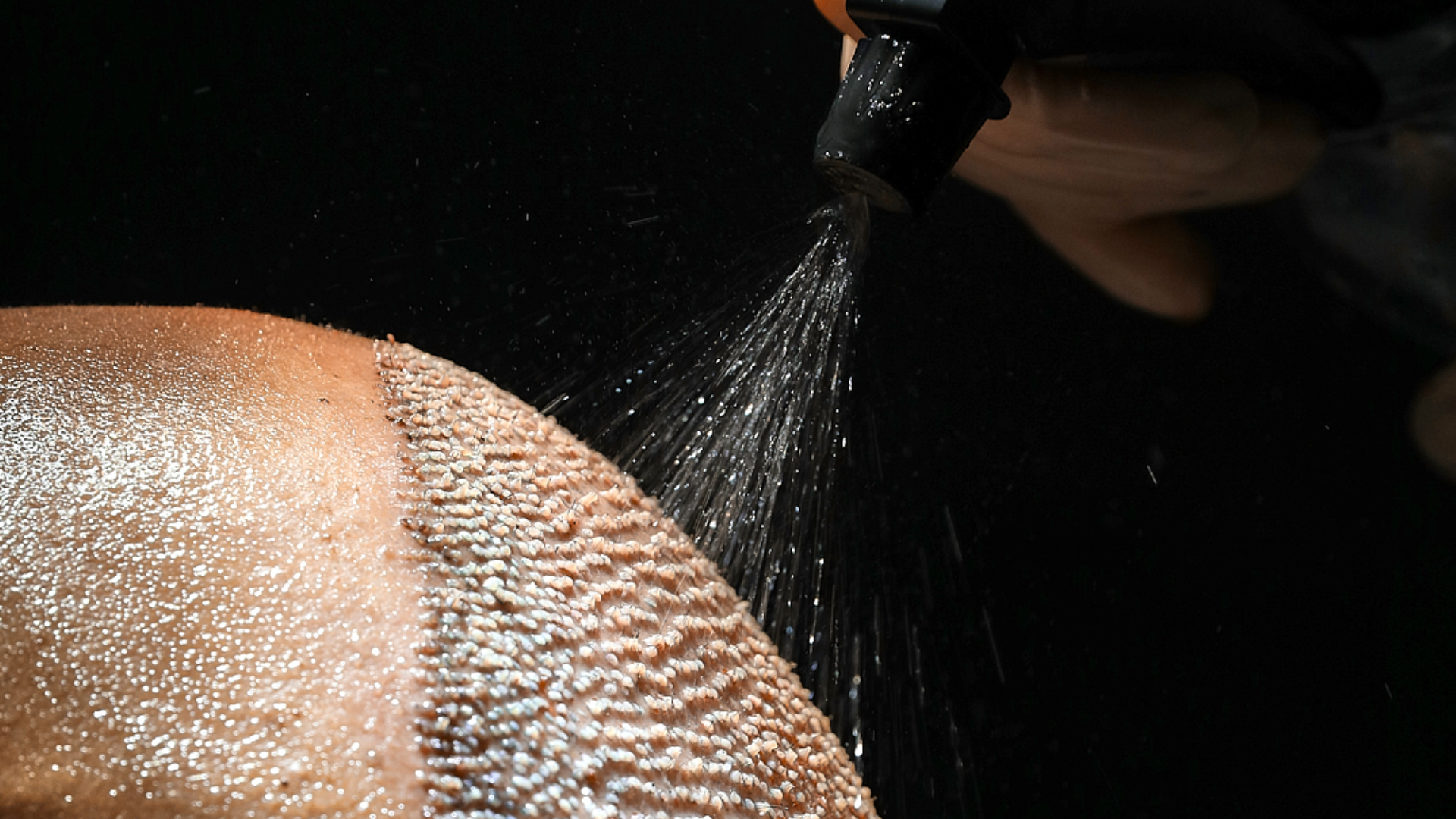 désinfection des greffons après une greffe de cheveux FUE