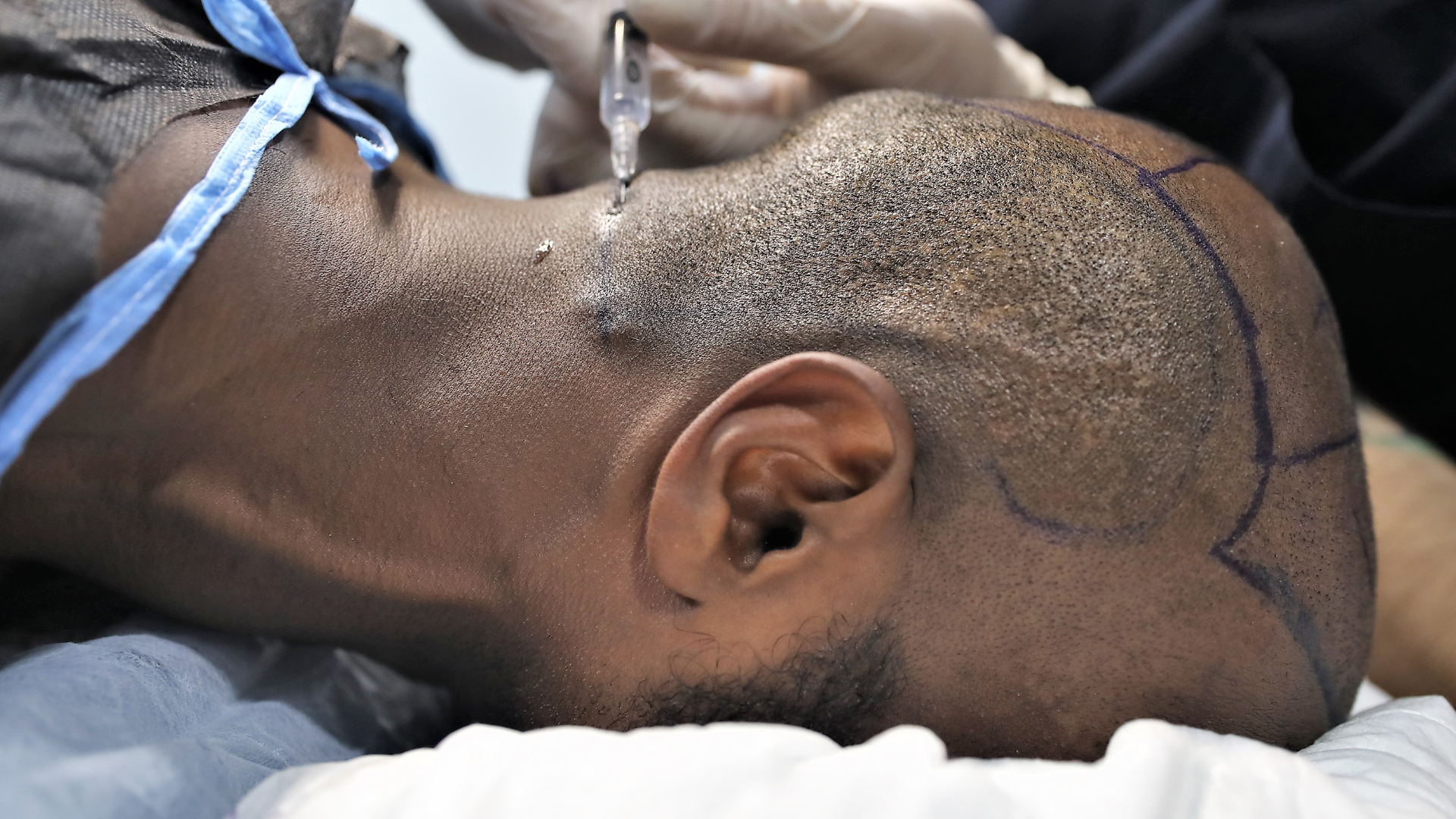 un patient se fait prélever des follicules capillaire dans sa zone donneuse à l’arrière de son crâne dans le cadre d’une transplantationn de cheveux