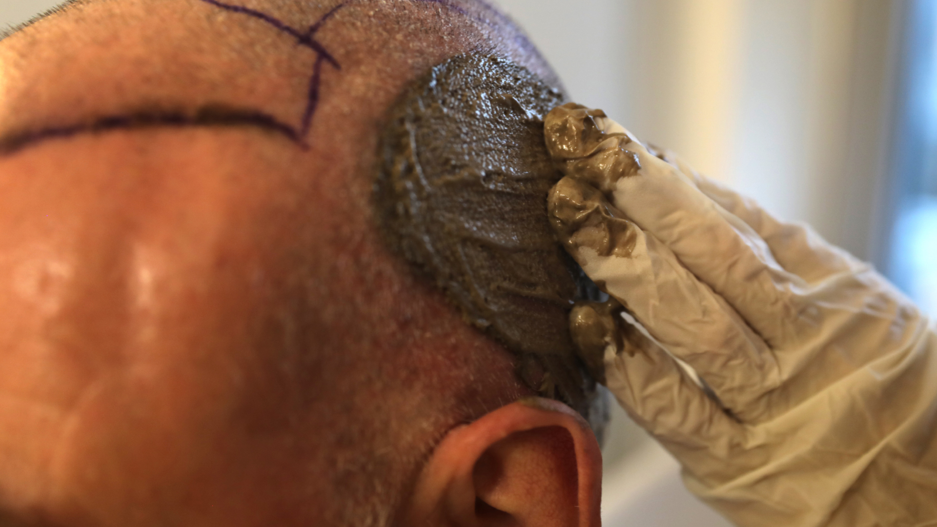 a man has a healing cream applied to his donor area