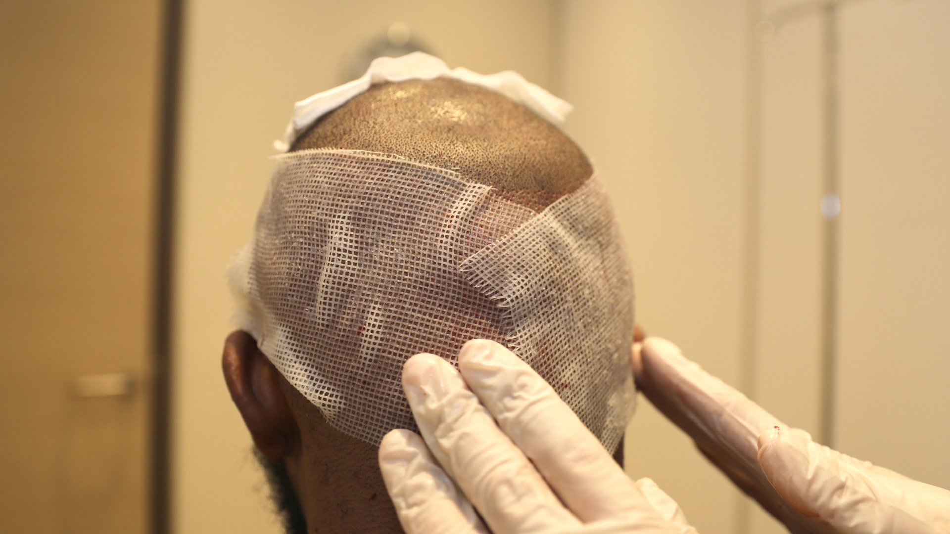 Un chirurgien spécialiste de la greffe de cheveux prend soins de la zone donneuse d'un patient