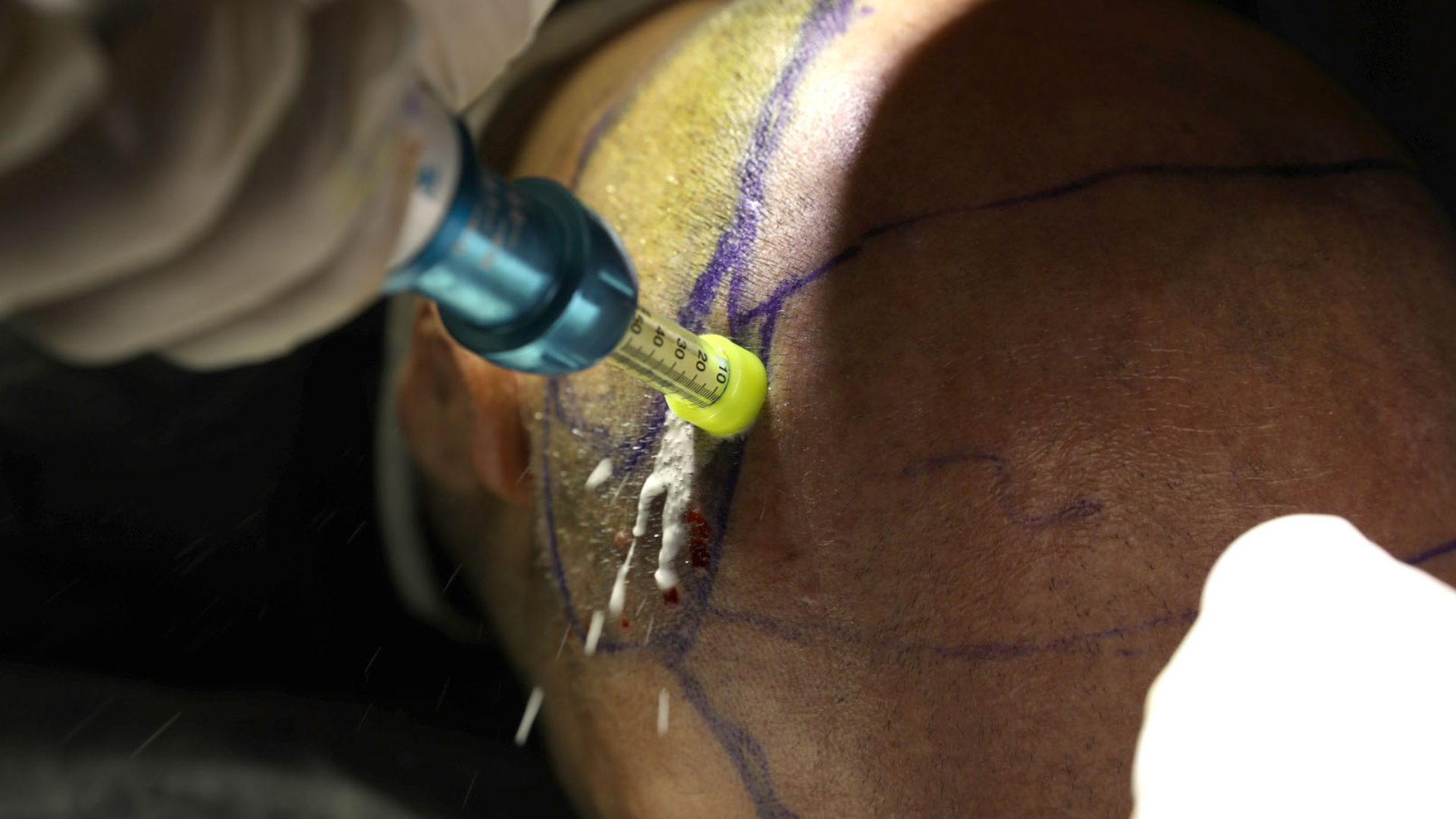 un patient se fait implanter des follicules capillaires préalablement prélevées dans sa zone donneuse dans le cadre d’une greffe de cheveux