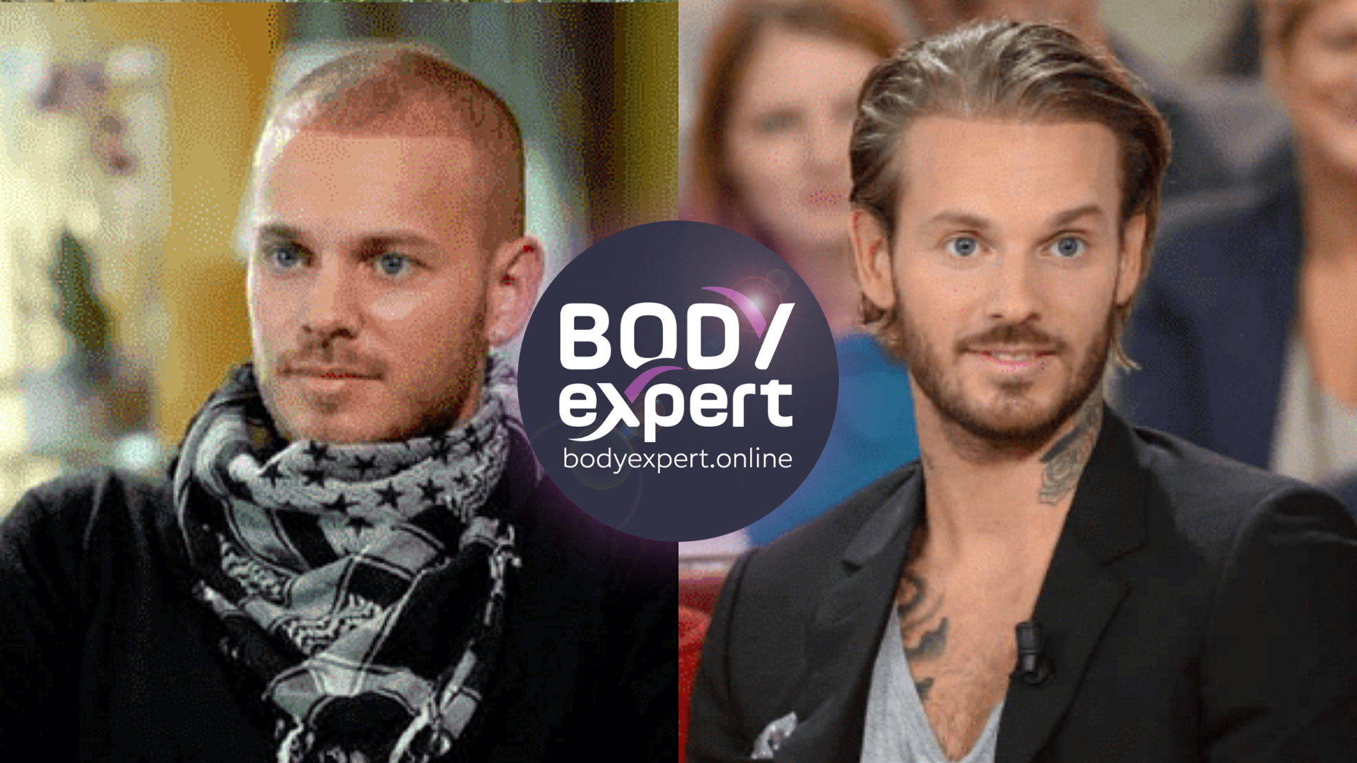 Matt Pokora avant et après sa greffe de cheveux