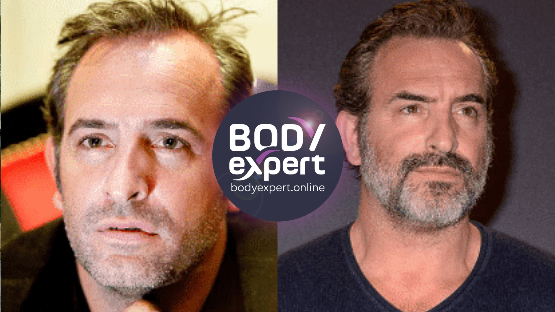 Jean Dujardin avant et après sa greffe de cheveux