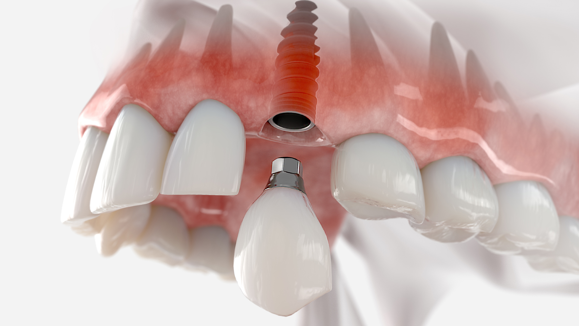 une couronne dentaire vissée sur implant