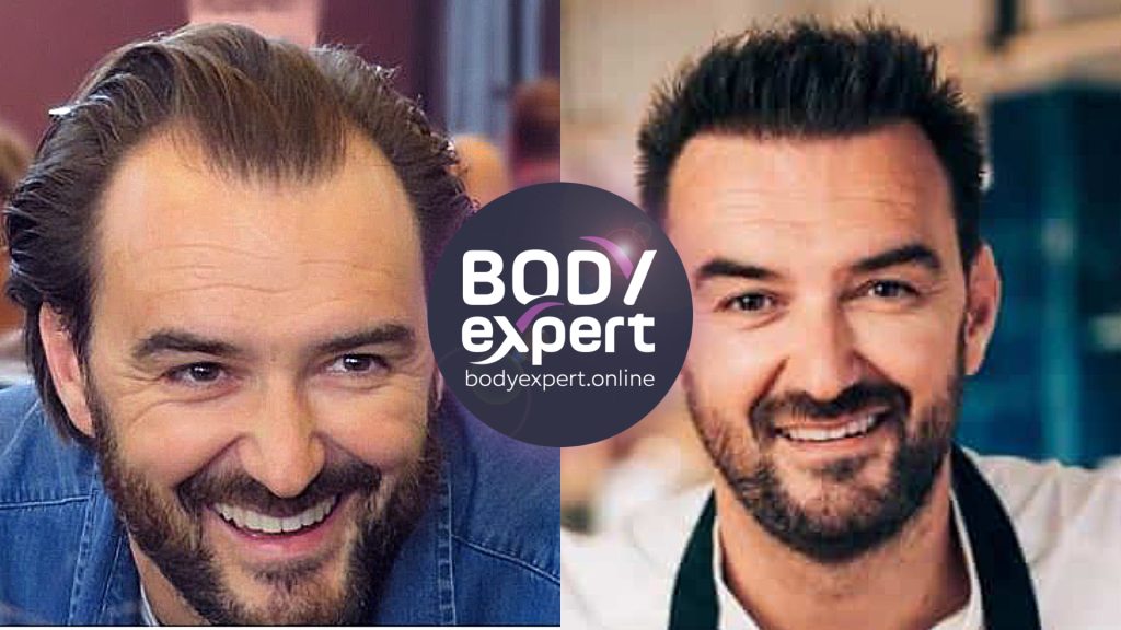 Greffe de cheveux quelle star a des implants capillaires