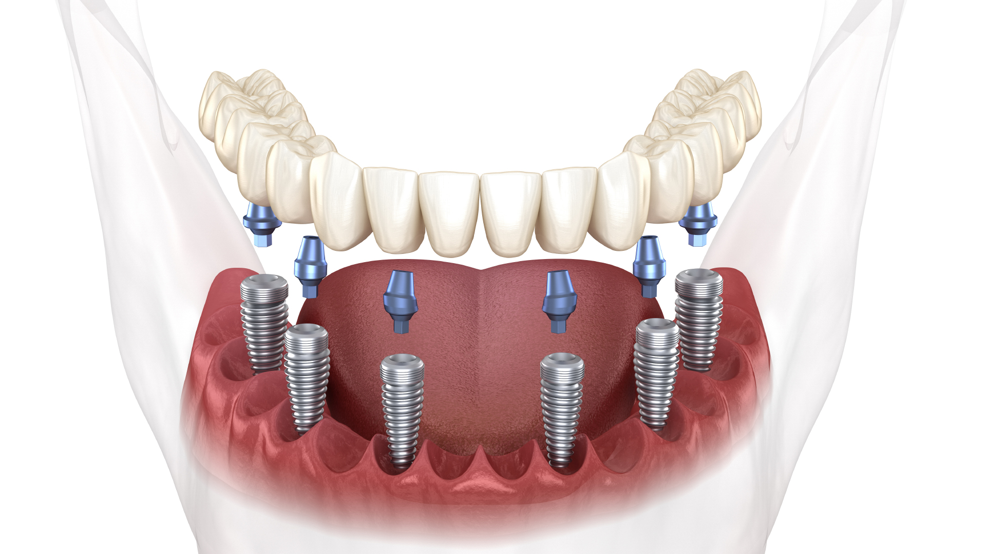 un bridge transvissé sur 6 implants