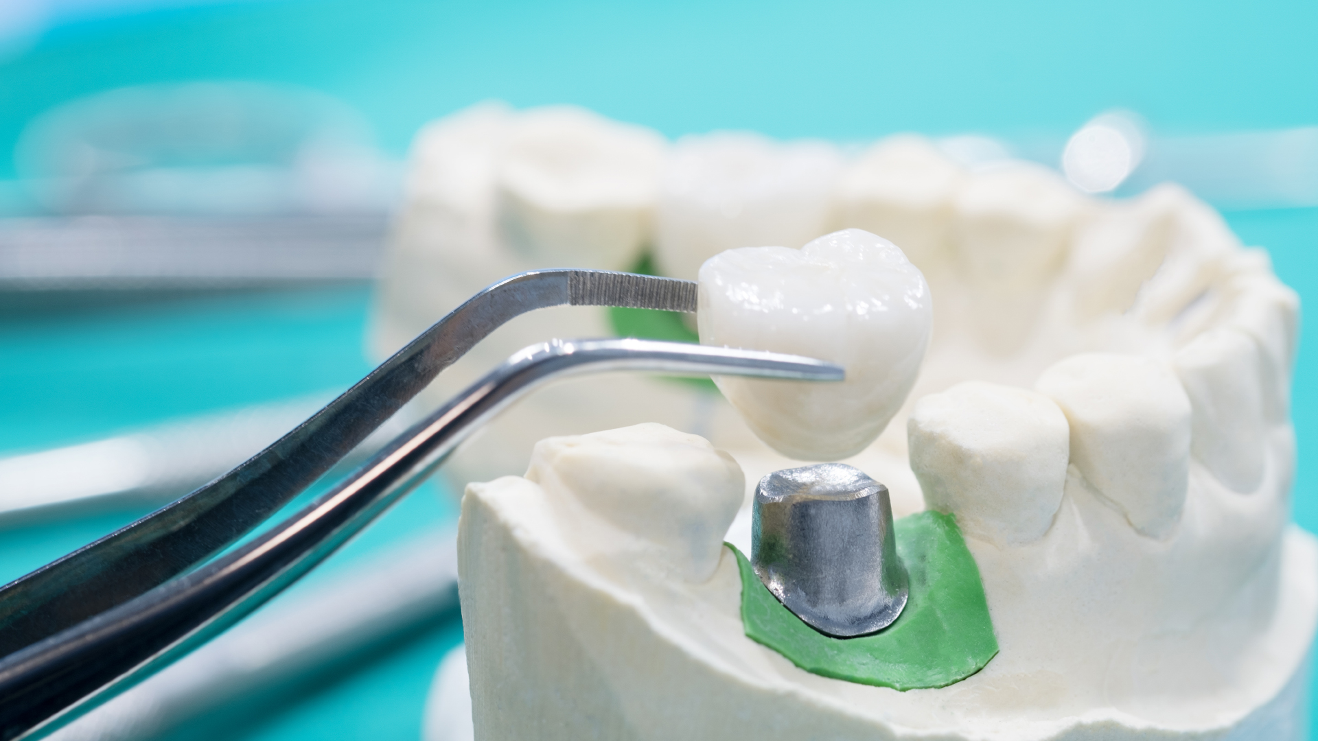 model of a dental prosthesis on abutment