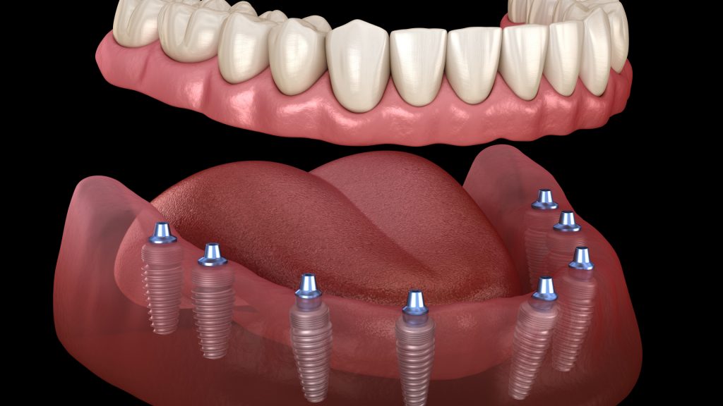 Kits D'ancrages Dentaires Mini 3.2mm & 3mm Avec Bouchons Mâles Pour Prothèses Sur Implants Hiossen