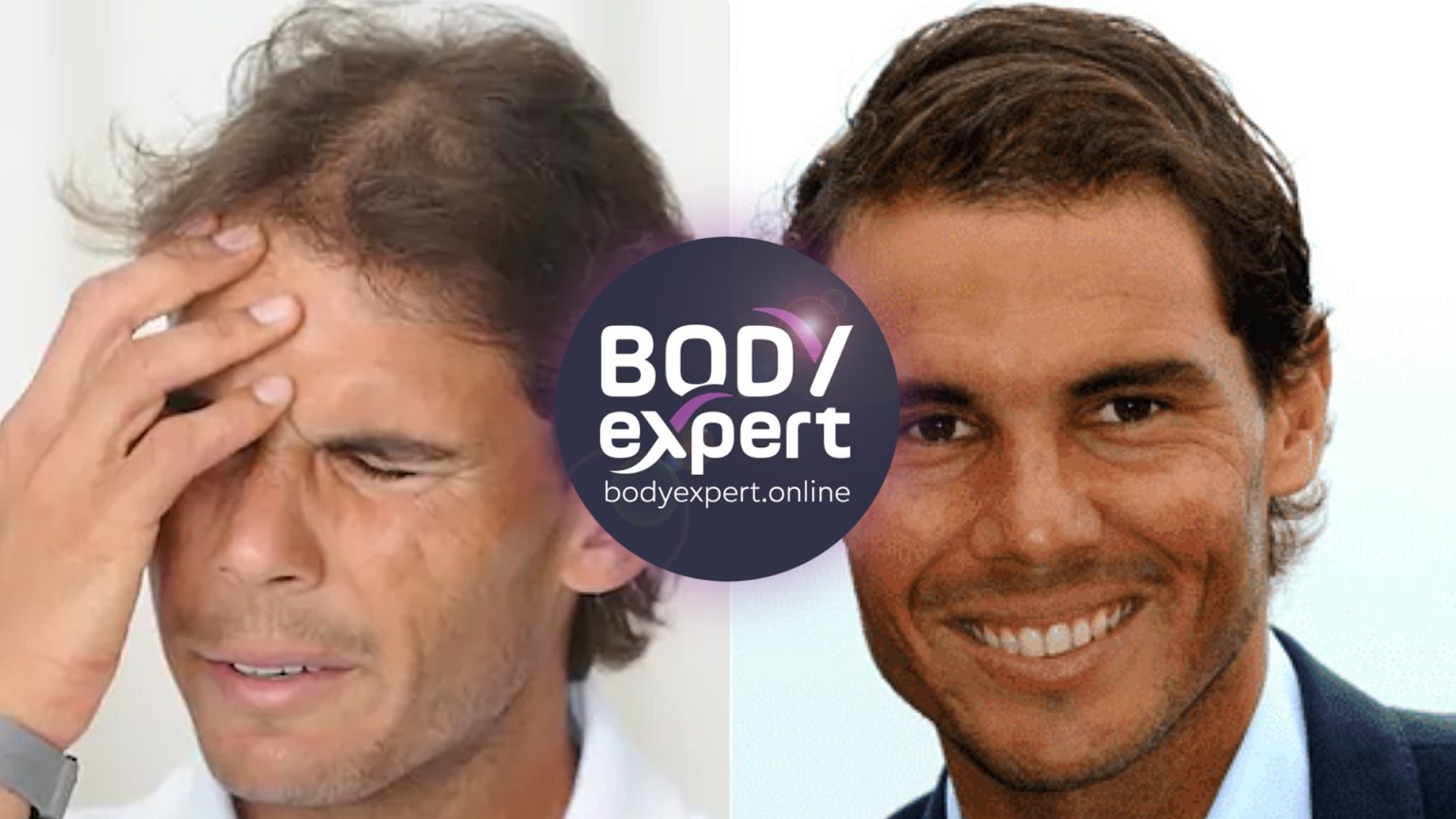 Hair transplant: which celebrity has a hair transplant?