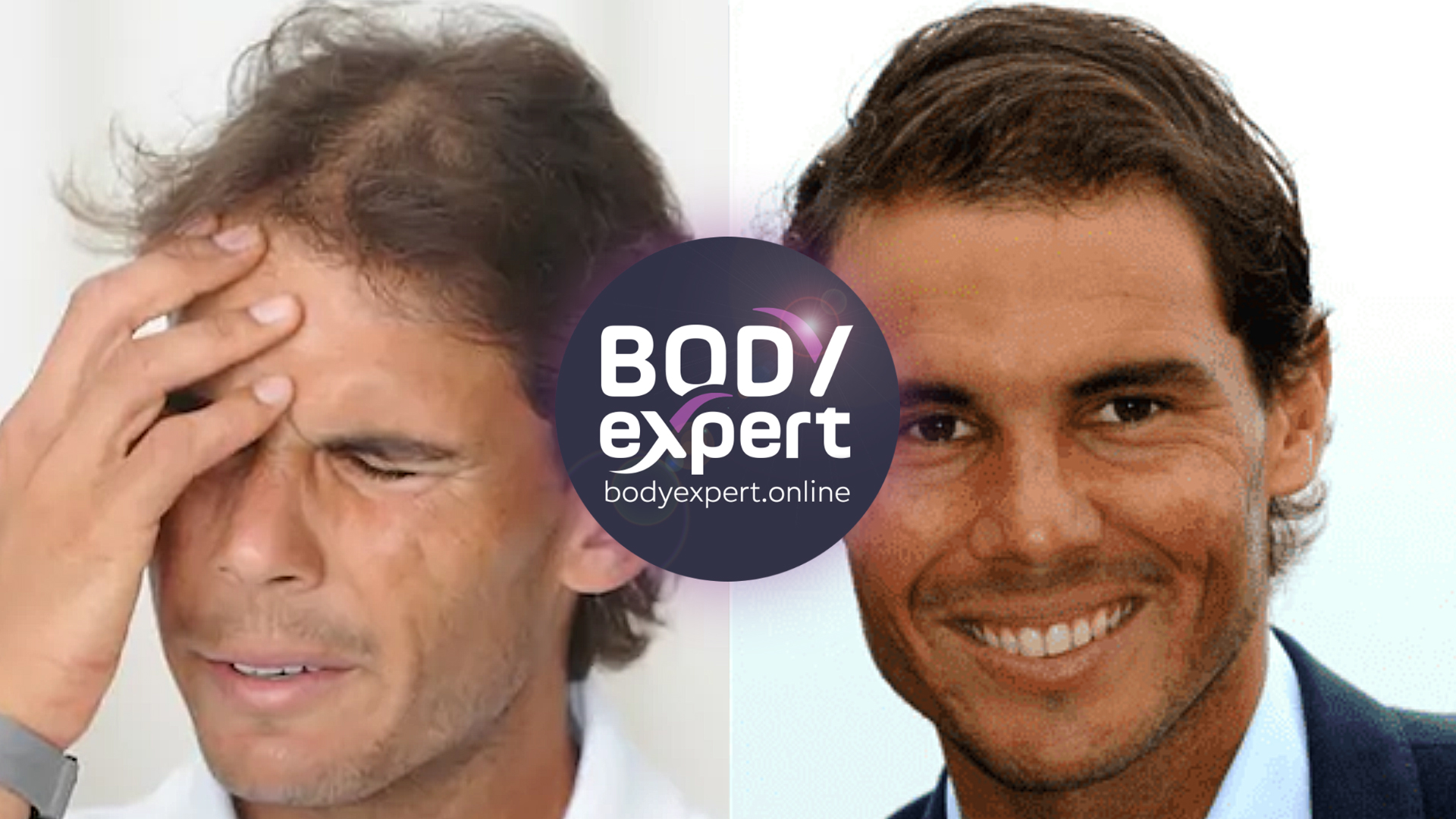 Rafael Nadal avant et après sa greffe de cheveux