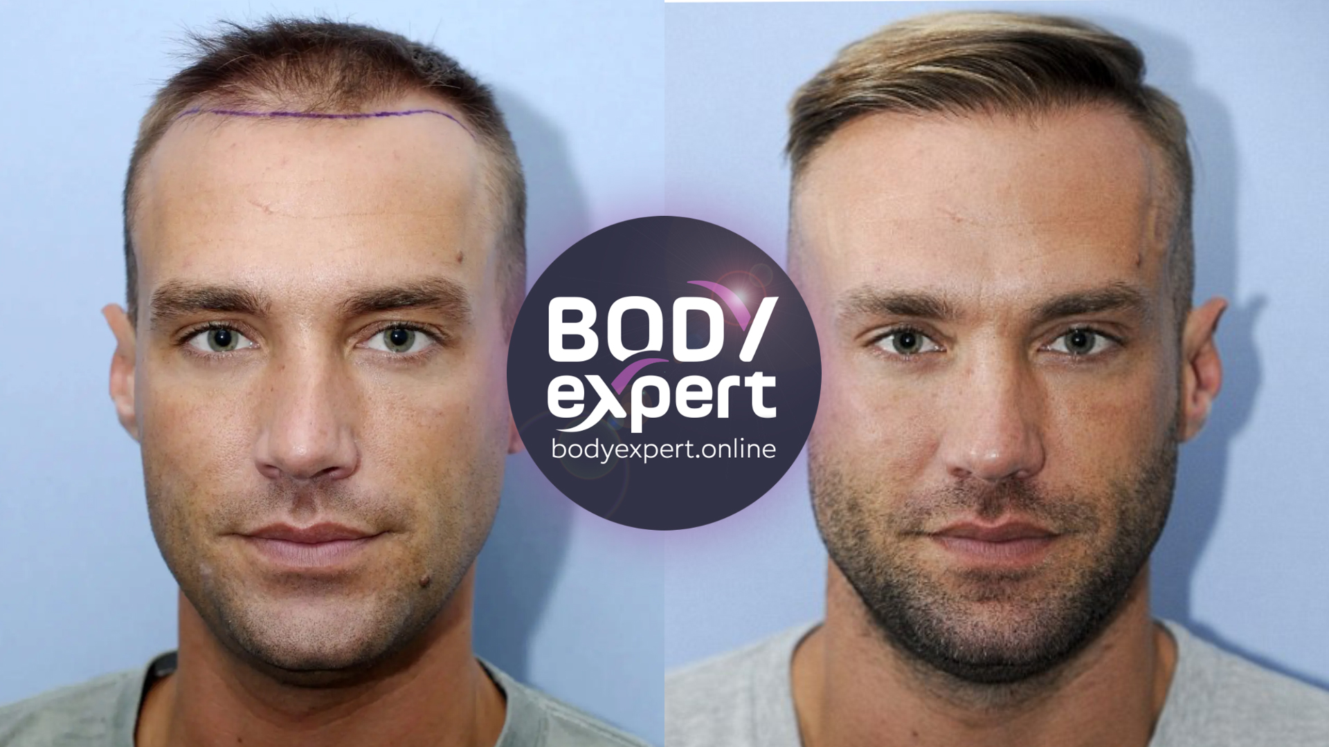 has Calum Best had a hair transplant? Yes!