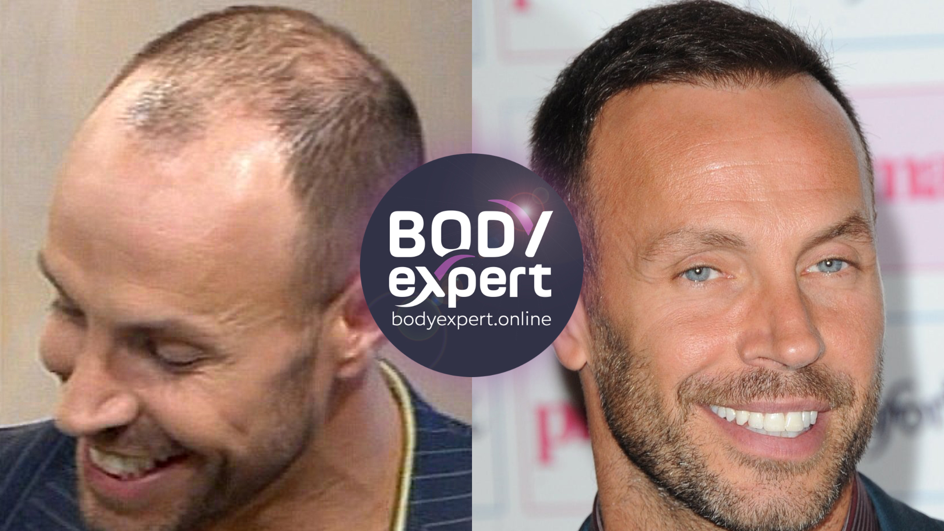 Hair transplant: which celebrity has a hair transplant?