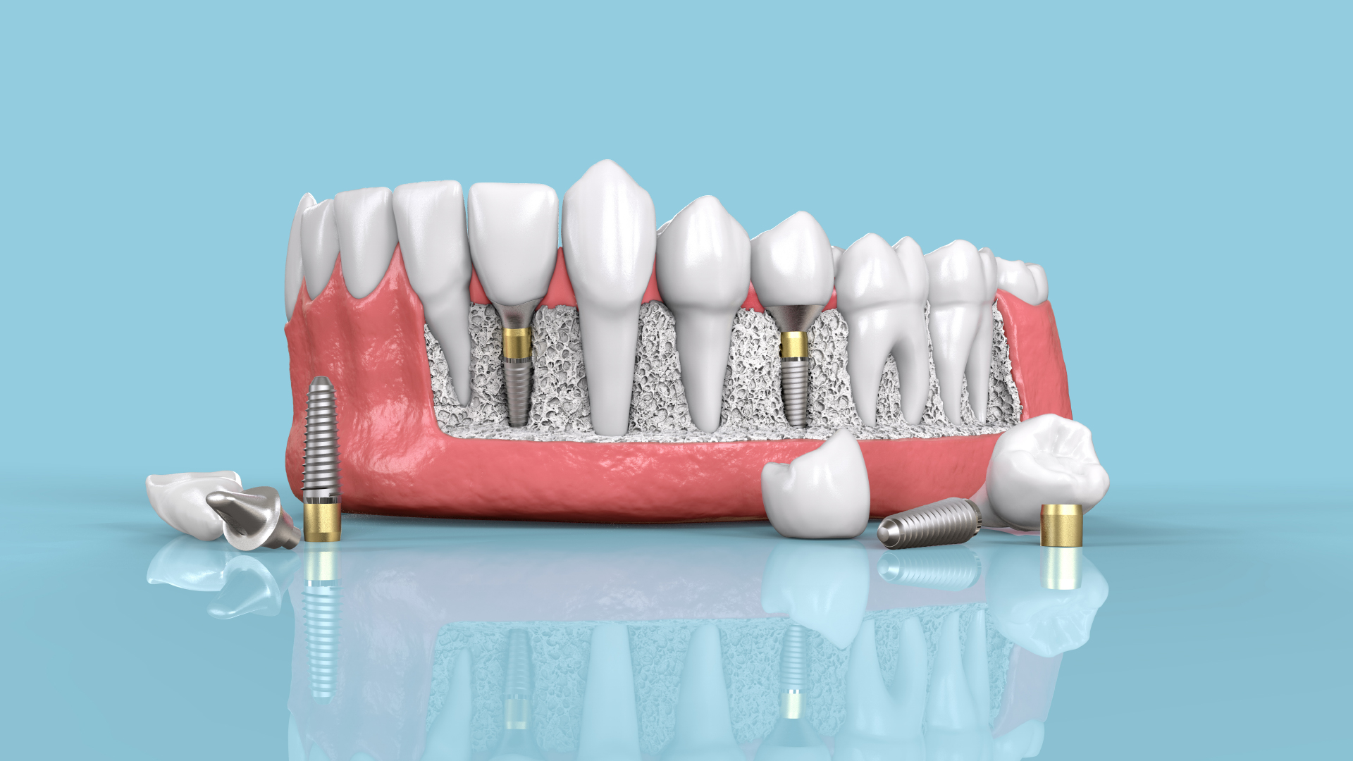 Ciment dentaire définitif pour la fixation de ponts et couronnes