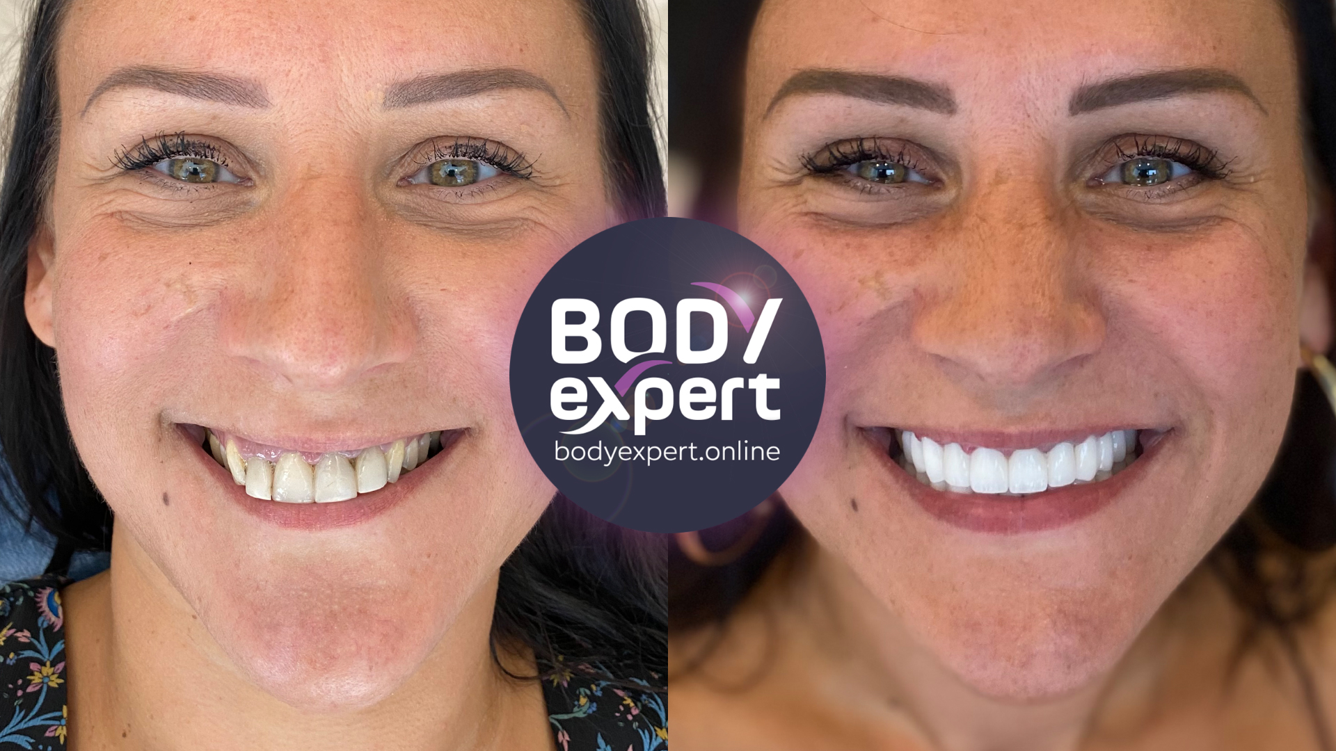 Couronnes dentaire Avant Après, résultats après la pose Body Expert