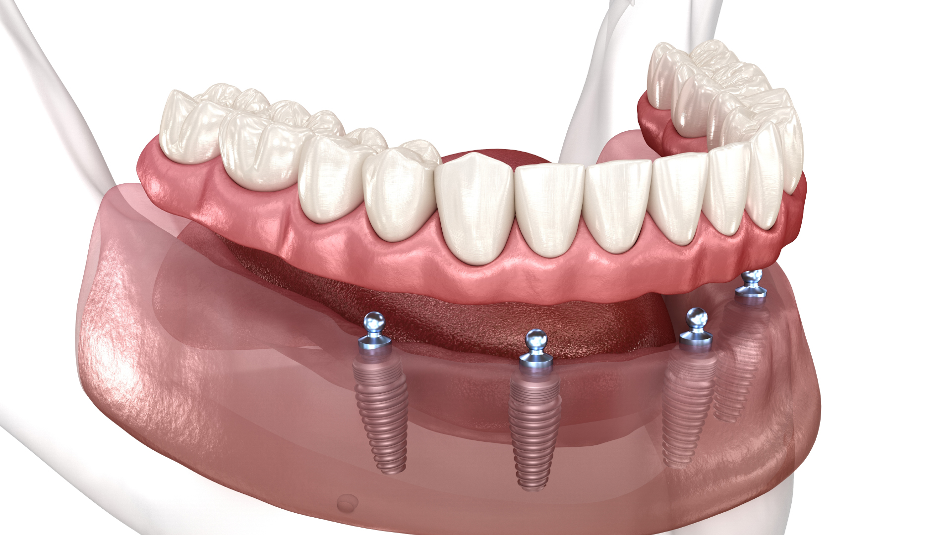 a 3D model of All-on-4