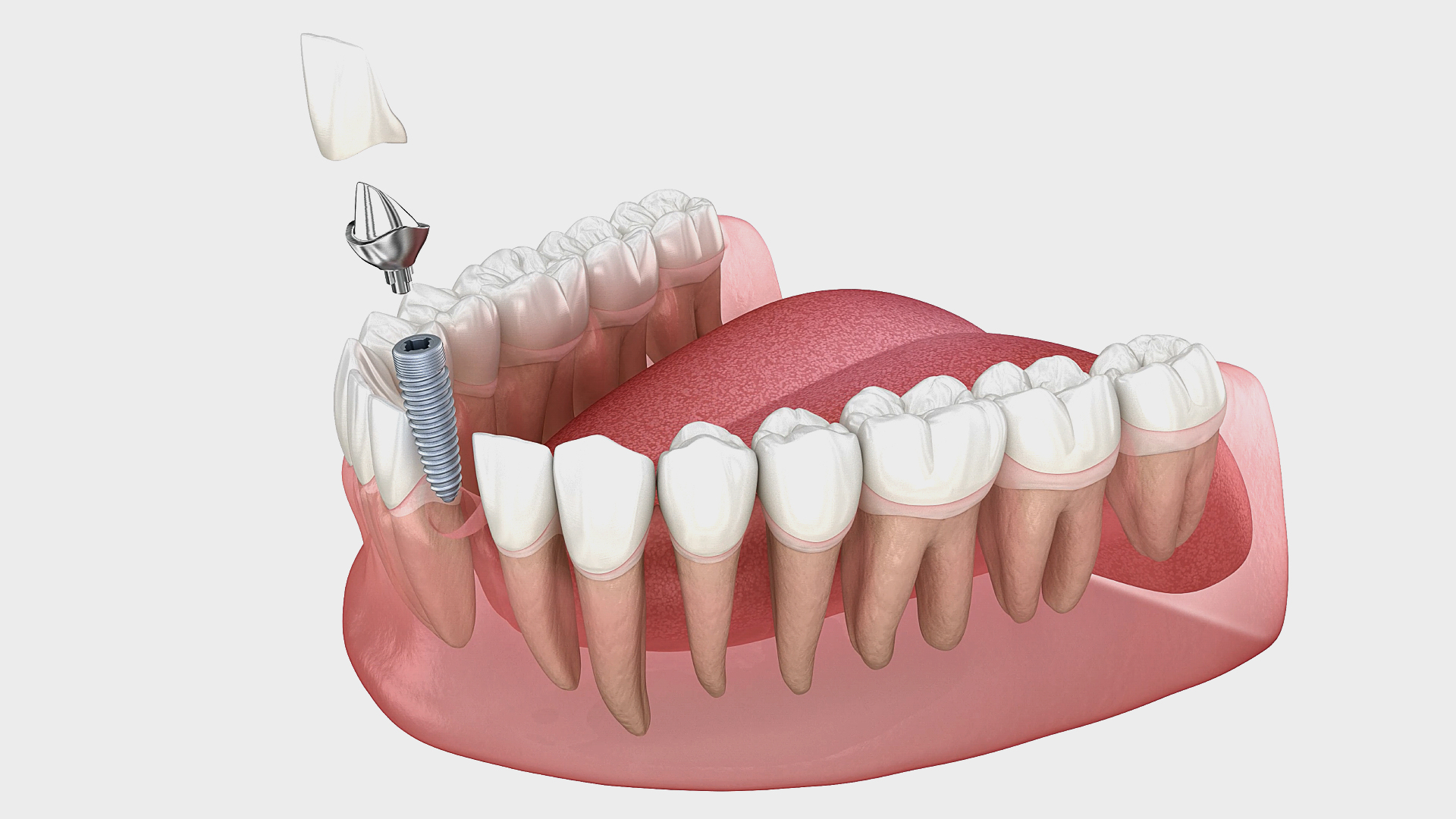vue 3D de la bouche d’un patient et de son implant dentaire