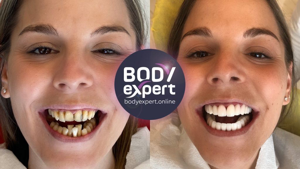 Implants dentaires Avant Après résultats après la pose Body Expert