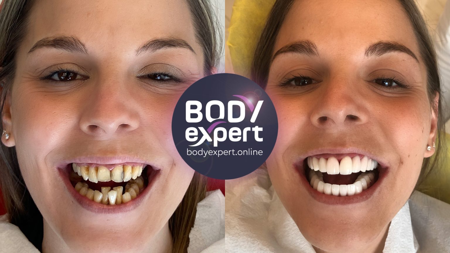 Implants dentaires Avant Après résultats après la pose Body Expert