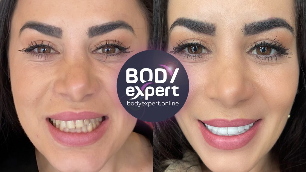 04-Tiffany-Avant-Apres-Couronnes-dentaires