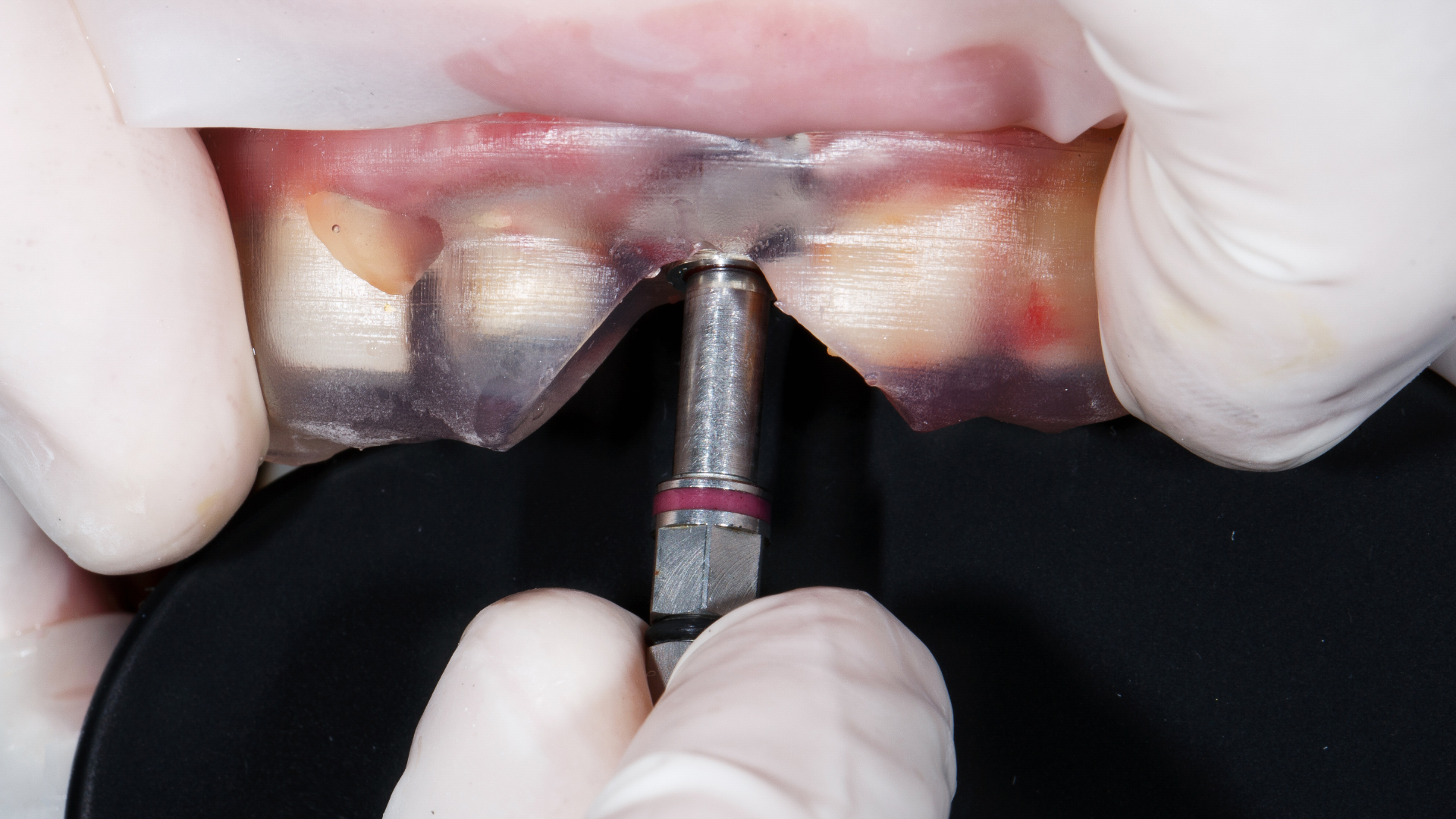 a dental surgeon places dental implants