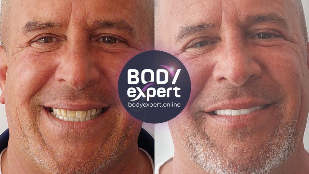 05-Ronnie-Avant-Apres-Couronnes-dentaires